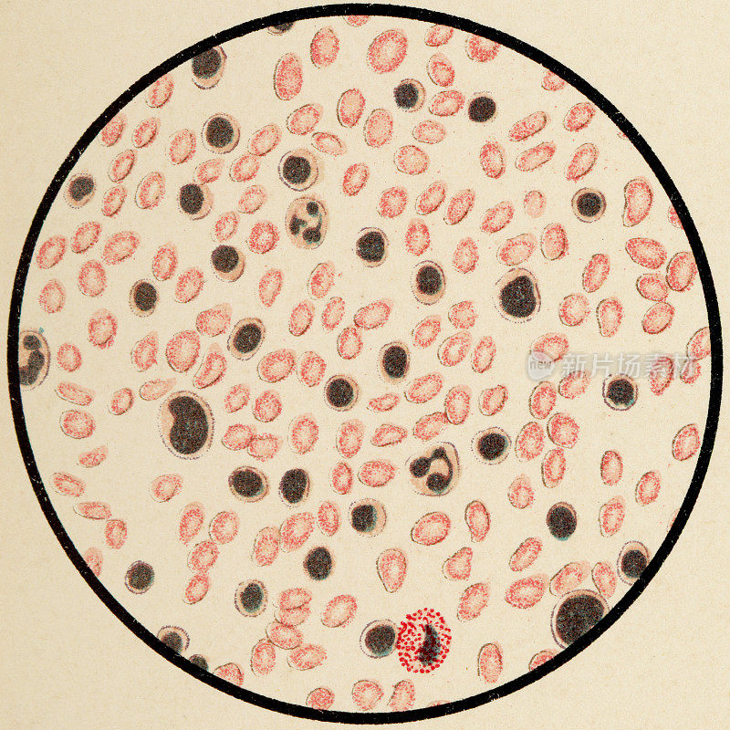 淋巴样白血病患者的人血细胞显微镜观察，苏木精和伊红染色- 19世纪